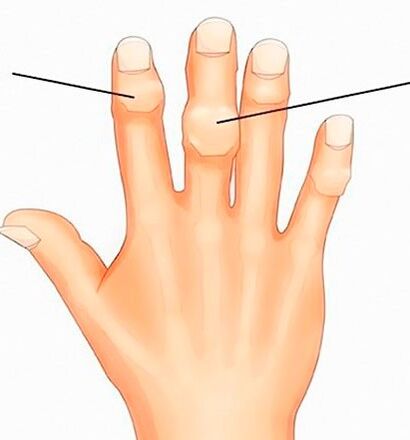 Heberdenove a Bouchardove uzliny na interfalangeálnych kĺboch ​​s artrózou