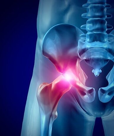 bolesť bedrového kĺbu fotka 1