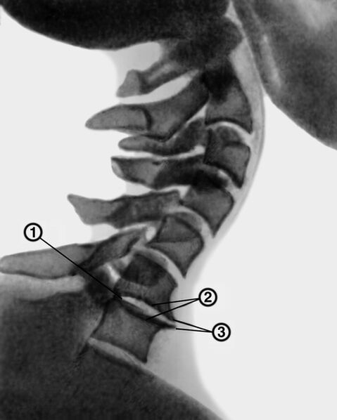 Röntgen krčnej chrbtice s osteochondrózou