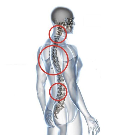 Ako sa prejavuje osteochondróza