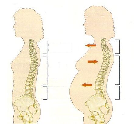 osteochondróza počas tehotenstva