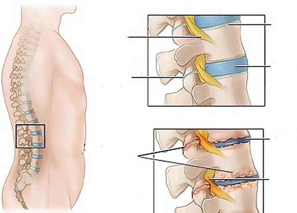 zmeny na diskoch v dôsledku osteochondrózy